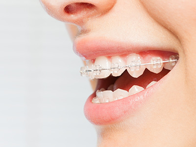 Orthodontic Braces in Albany GA