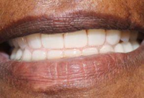 CEREC Dentist in Albany GA