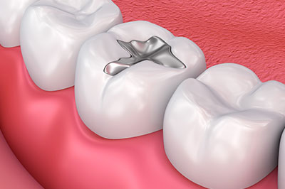 Mann Dental Care | Veneers, Snoring Appliances and Preventative Program