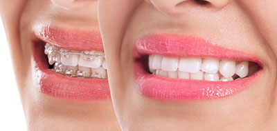 Dental Braces in Albany GA