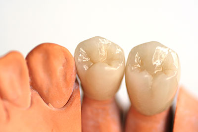 Mann Dental Care | Emergency Treatment, Crowns  amp  Caps and Dental Fillings