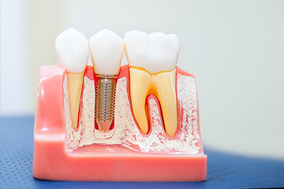 Mann Dental Care | Implant Restorations, Dental Fillings and Snoring Appliances