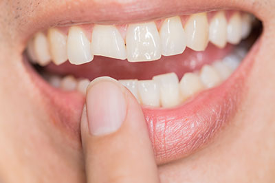 Mann Dental Care | Temporary Braces, Dental Fillings and Veneers