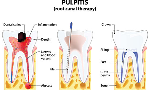 Mann Dental Care | Root Canals, Clear Aligners and Crowns  amp  Caps