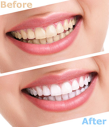 Mann Dental Care | Clear Aligners, Temporary Braces and Crowns  amp  Caps